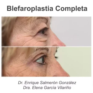 antes y después blefaroplastia completa de perfil