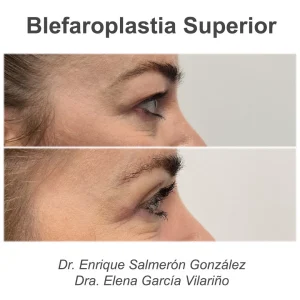 antes y después blefaroplastia de perfil