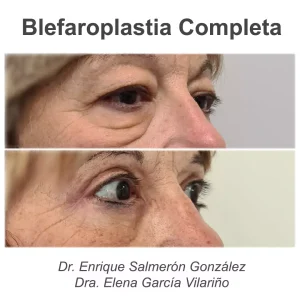 antes y después blefaroplastia completa de lado