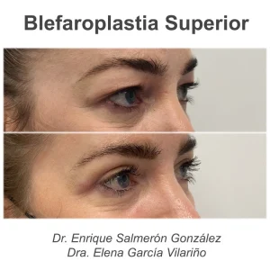 antes y después blefaroplastia de lado