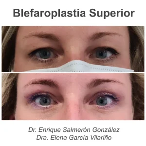 antes y después blefaroplastia superior de frente