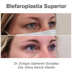 antes y después blefaroplastia superior de lado
