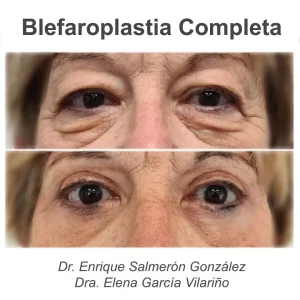antes y después blefaroplastia completa