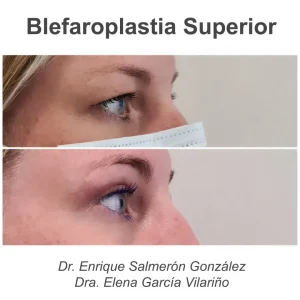 antes y después blefaroplastia superior de perfil