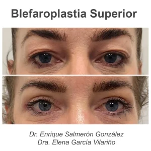 antes y después blefaroplastia