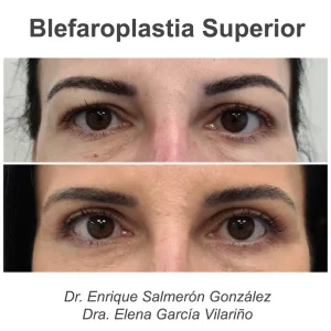 antes y después blefaroplastia de frente