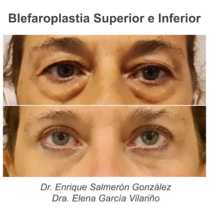 antes y después blefaroplastia completa