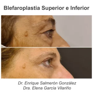 antes y después blefaroplastia completa de perfil