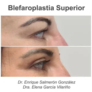 antes y después blefaroplastia de perfil
