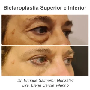 antes y después blefaroplastia completa