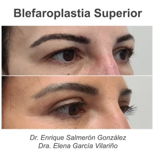 antes y después blefaroplastia de lado