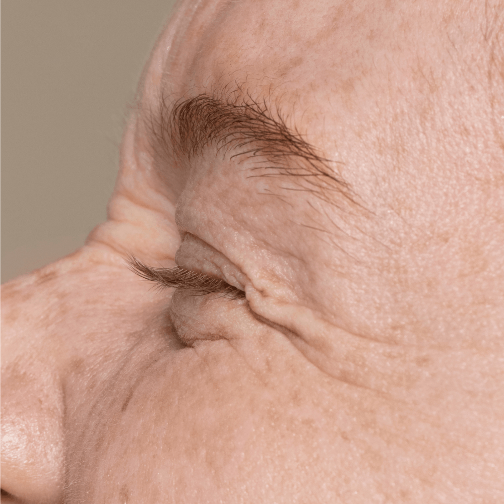 blefaroplastia-valencia