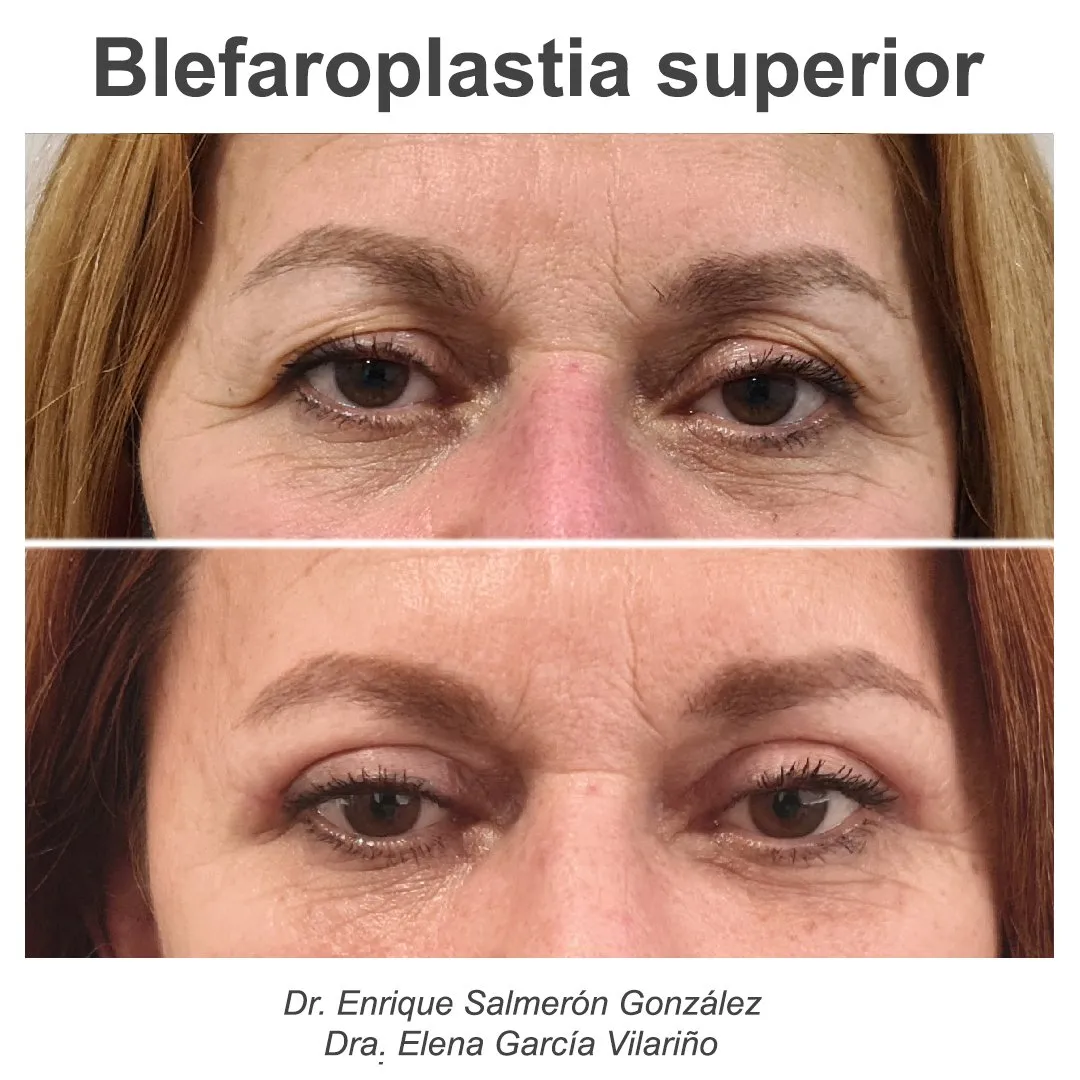 caso de antes y despues Blefaroplastia