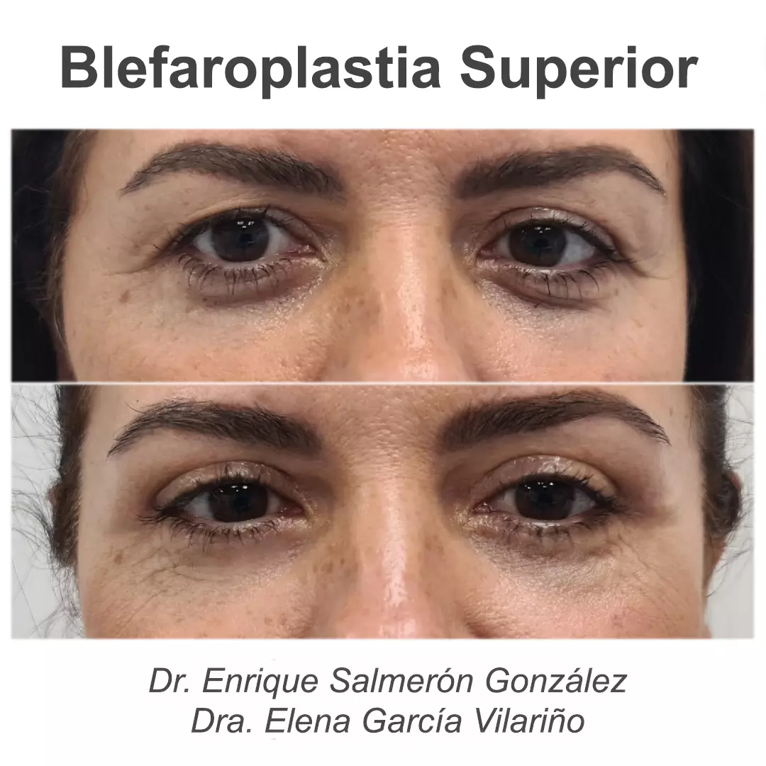 caso de antes y despues Blefaroplastia